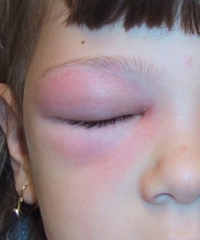 Clinical photograph showing marked right periorbital swelling and erythema in a febrile child.