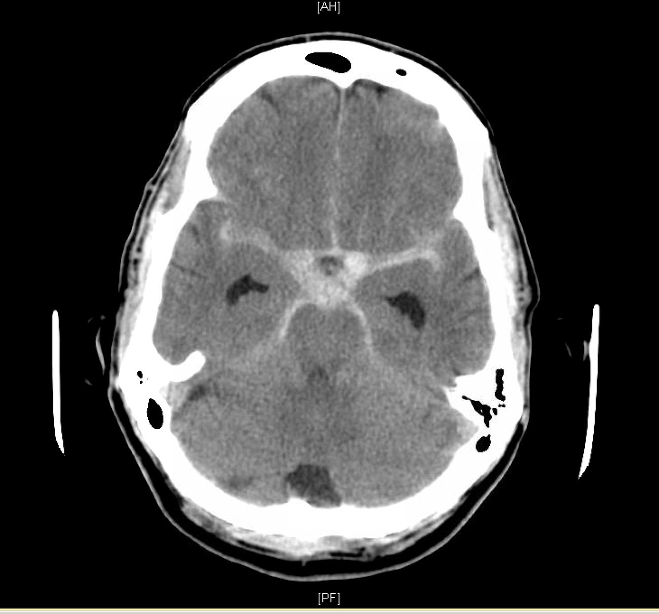 Non-contrast CT brain showing basal subarachnoid haemorrhage.