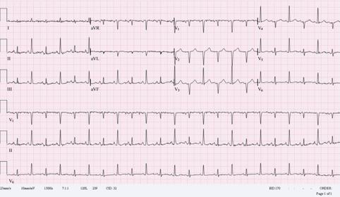 ECG showing sinus tachycardia, low voltage, and electrical alternans.