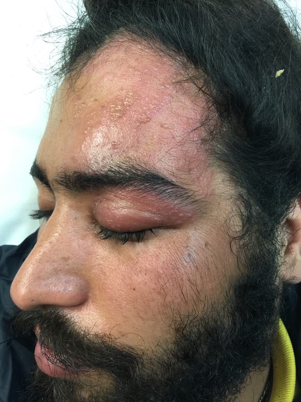 Clinical photograph showing a unilateral vesicular V1 facial rash with periorbital involvement.