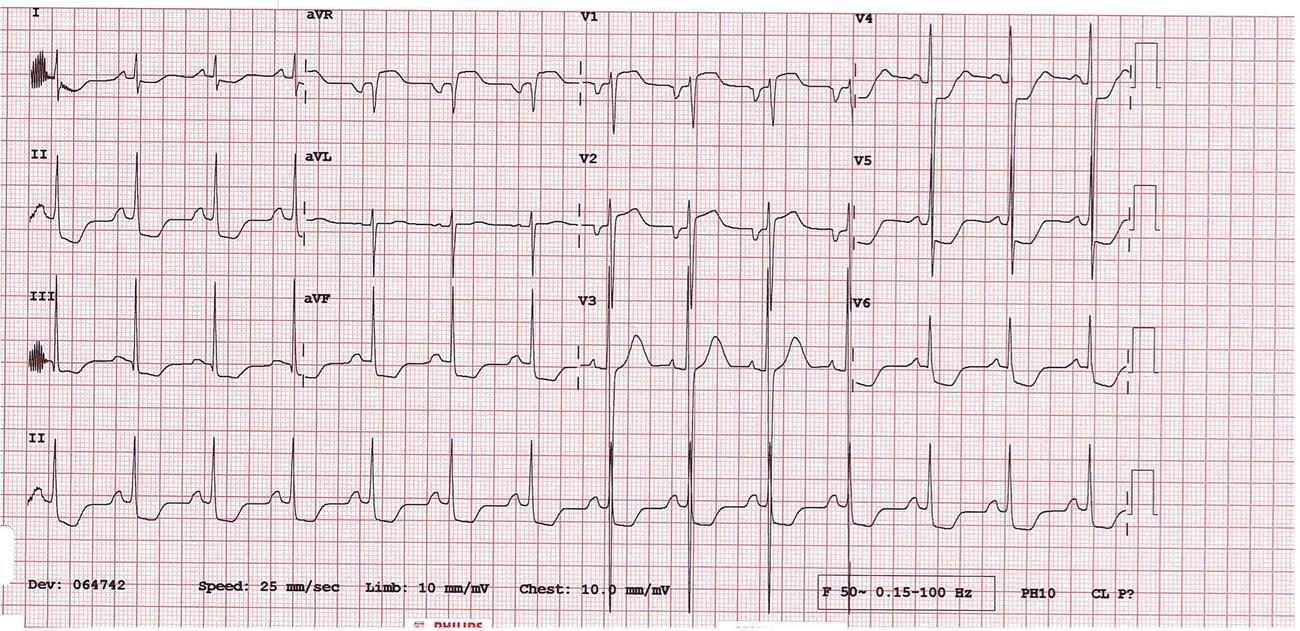 ECG in a child with exertional syncope showing features concerning for hypertrophic cardiomyopathy.