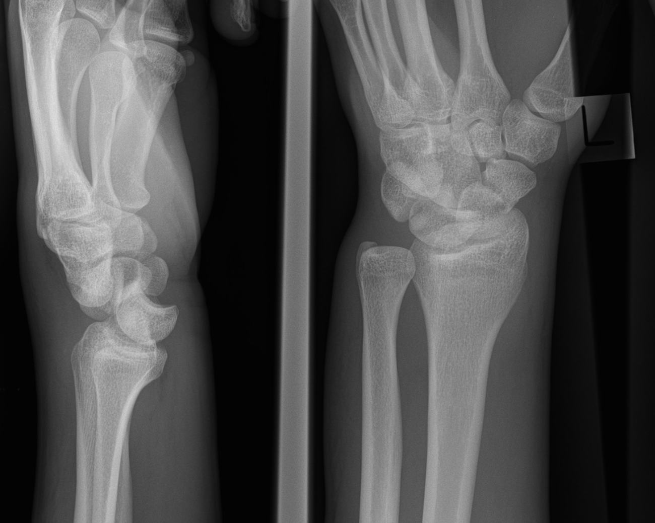 Left wrist x-ray showing a trans-scaphoid perilunate injury.
