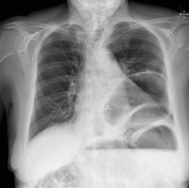 Chest x-ray showing a large intrathoracic gastric volvulus/hiatus hernia pattern.