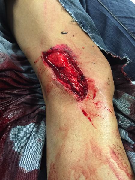 Clinical photograph showing a large lateral right knee laceration with exposed deep tissue.