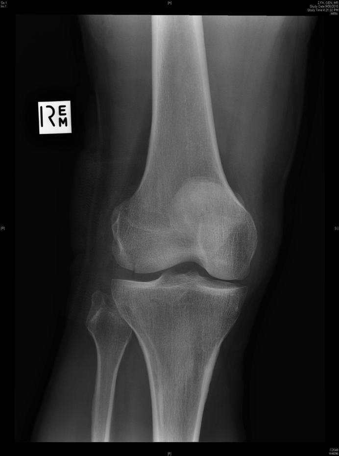 AP knee x-ray showing lateral femoral condyle fracture.