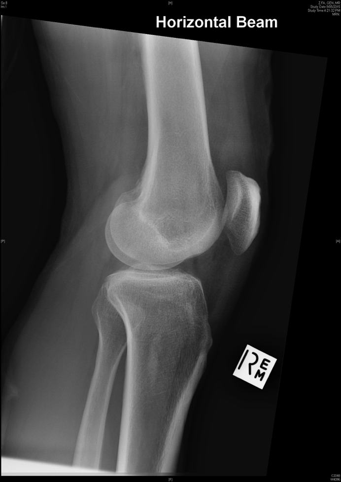 Lateral knee x-ray showing gas in the joint after open injury.