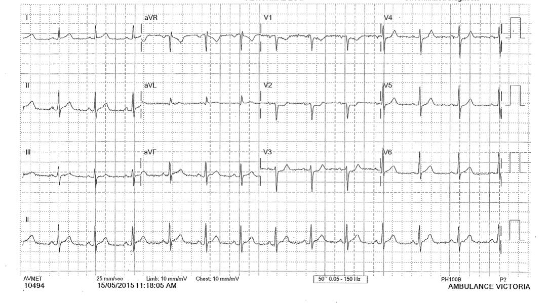 ECG showing anterior ST depression concerning for posterior STEMI.