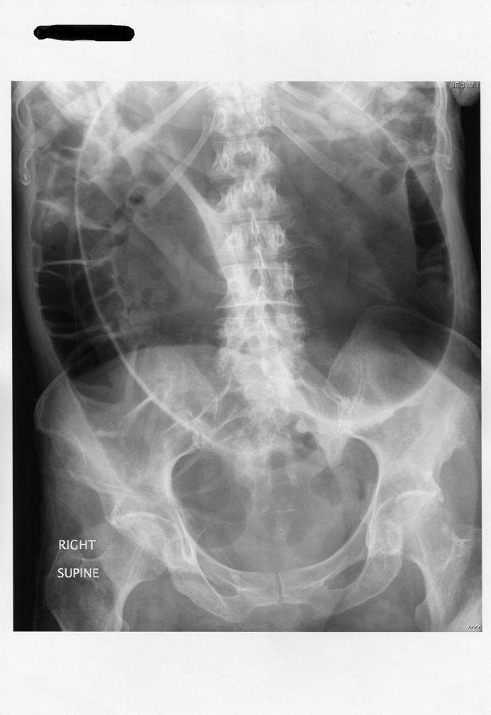 Abdominal x-ray showing a large coffee-bean loop consistent with sigmoid volvulus.