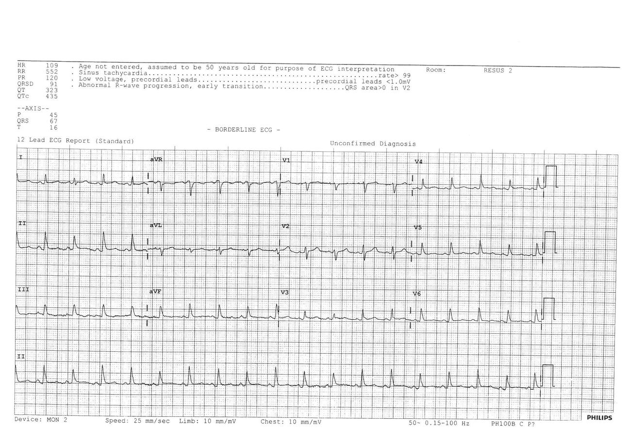 ECG showing sinus tachycardia, low voltage and electrical alternans consistent with tamponade.