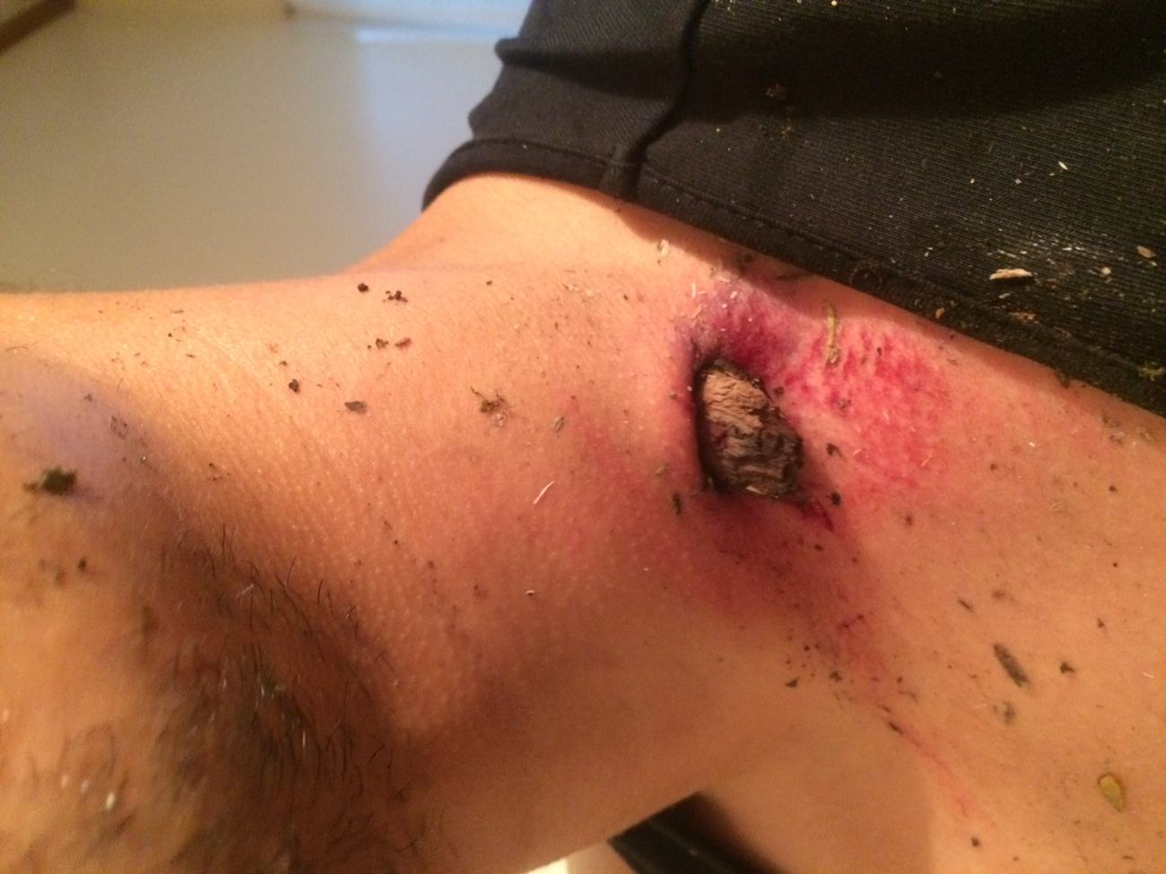Clinical photograph showing a contaminated penetrating wound at the lower neck.