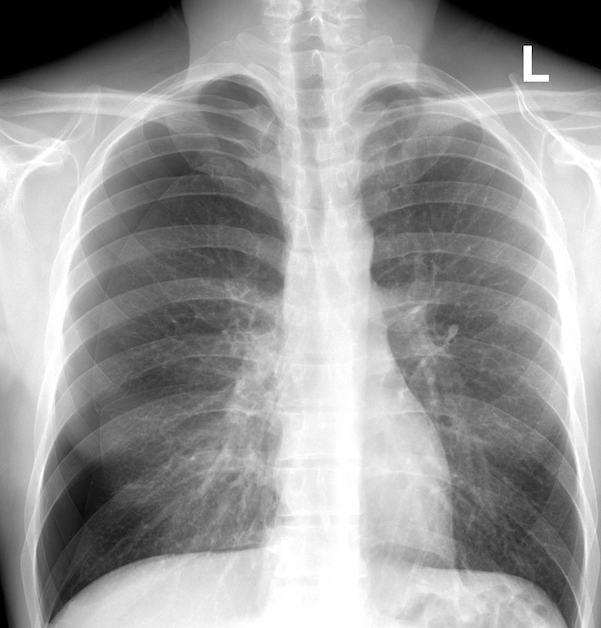 Chest x-ray showing a large right pneumothorax without clear tension features.