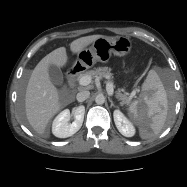 CT abdomen showing splenic injury with free intraperitoneal fluid.