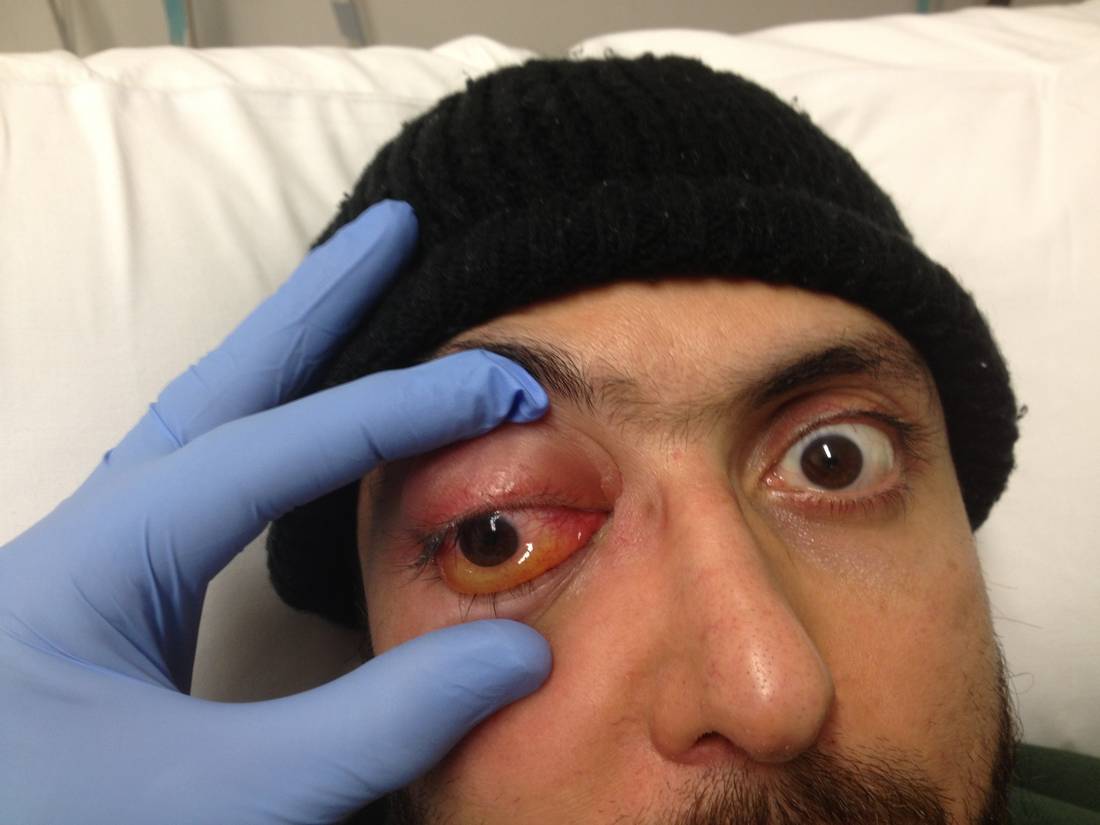 Clinical photograph showing right eye swelling, proptosis and ophthalmoplegia.