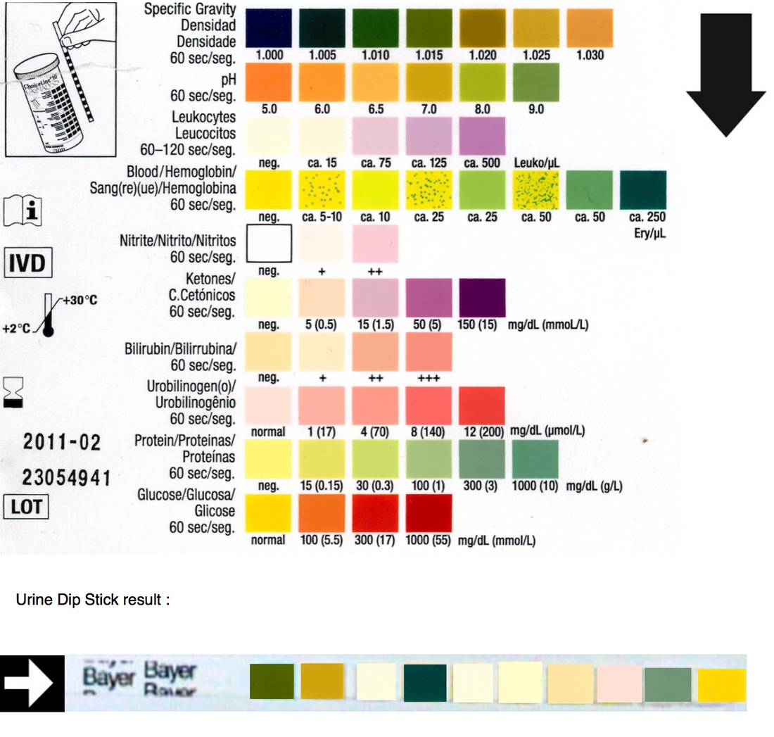 Urine dipstick showing heavy blood and protein with no nitrites or leukocytes.