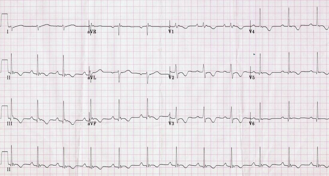 Baseline ECG with right precordial abnormalities concerning for ARVC.