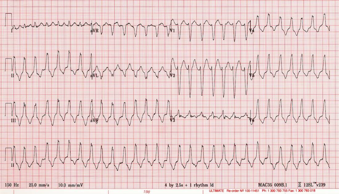 ECG showing unstable broad-complex tachycardia.