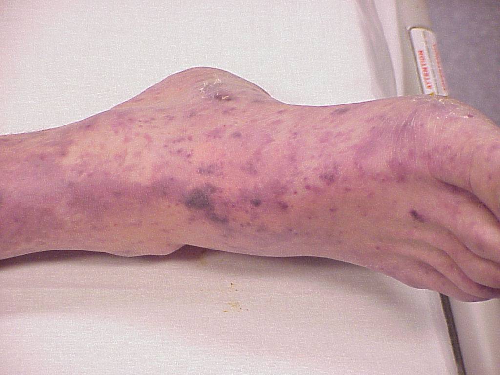 Clinical photograph of a purpuric rash consistent with meningococcal septicaemia.
