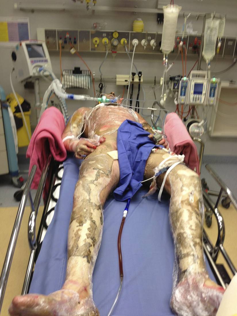 Clinical photograph of an intubated patient with extensive burns.