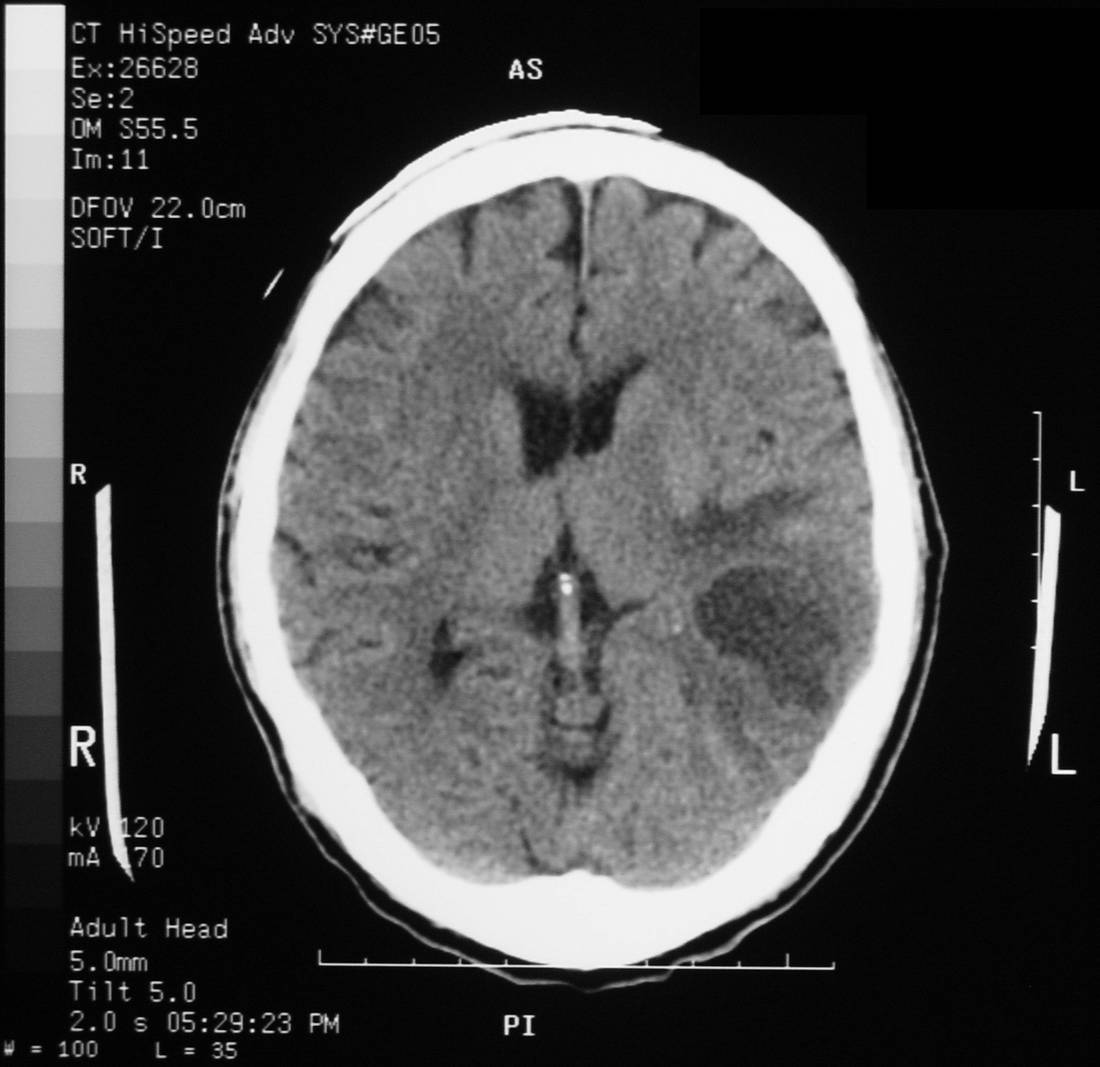 CT brain slice showing a left cerebral lesion with surrounding oedema.