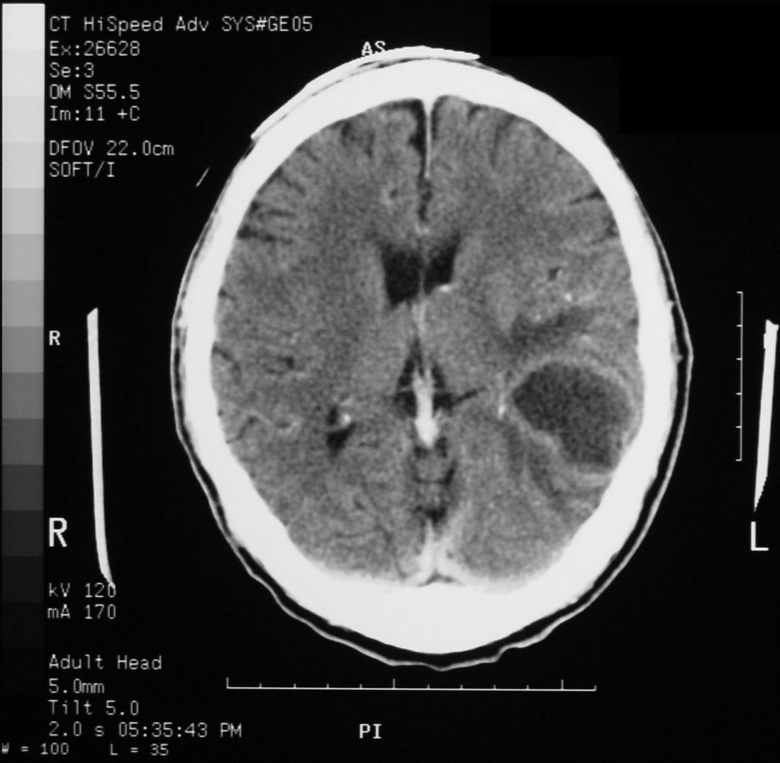 Contrast CT brain slice showing ring enhancement of the lesion.