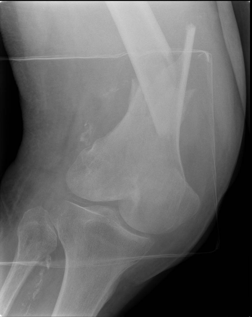 AP knee x-ray showing distal femur fracture.