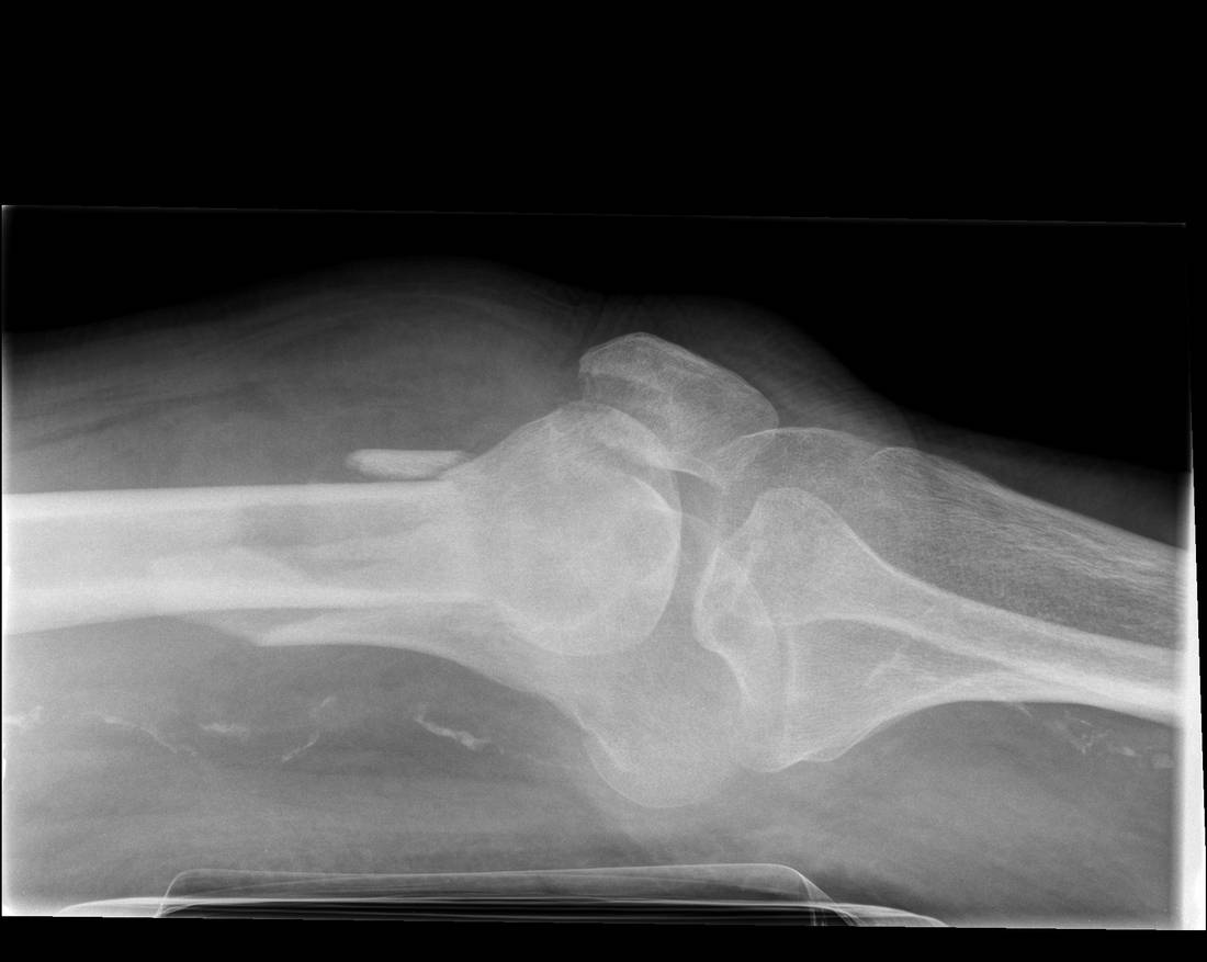 Lateral knee x-ray showing distal femur fracture.