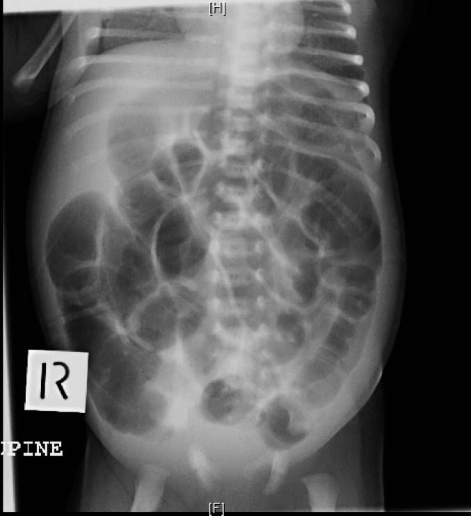 Abdominal x-ray of a 4-week-old infant with abdominal distension.