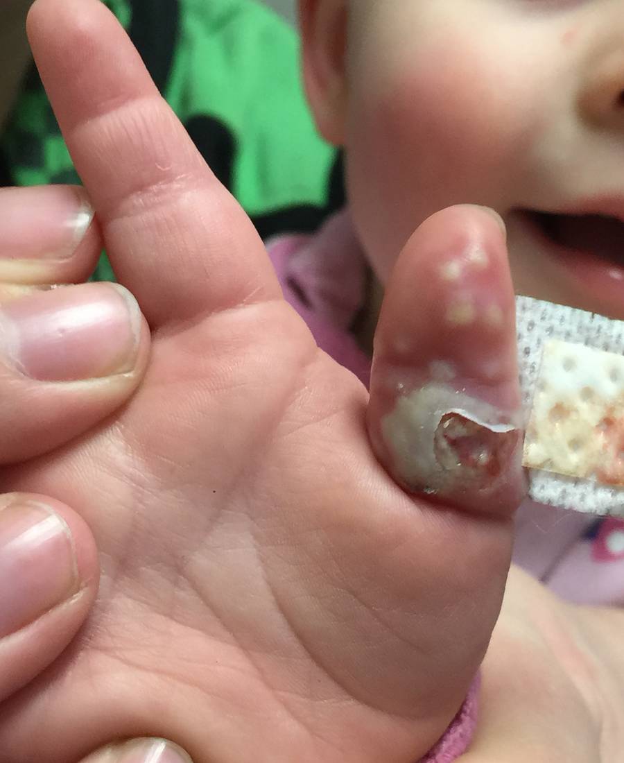 Clinical photograph of vesicular lesions and nail-fold inflammation on a child's thumb.