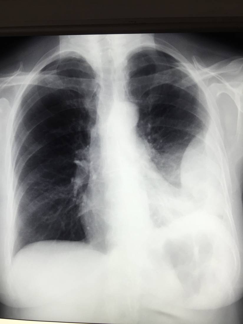 AP chest x-ray in a woman with left-sided chest pain and dyspnoea.
