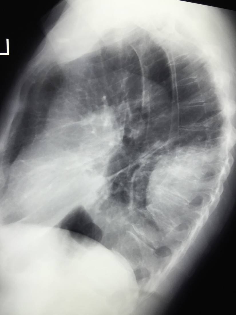 Lateral chest x-ray in a woman with left-sided chest pain and dyspnoea.