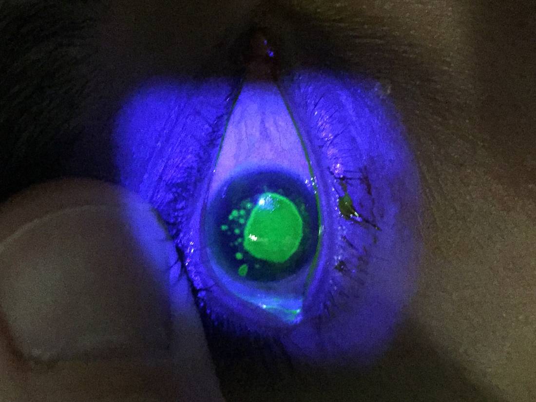 Slit-lamp fluorescein photograph showing a corneal epithelial lesion.