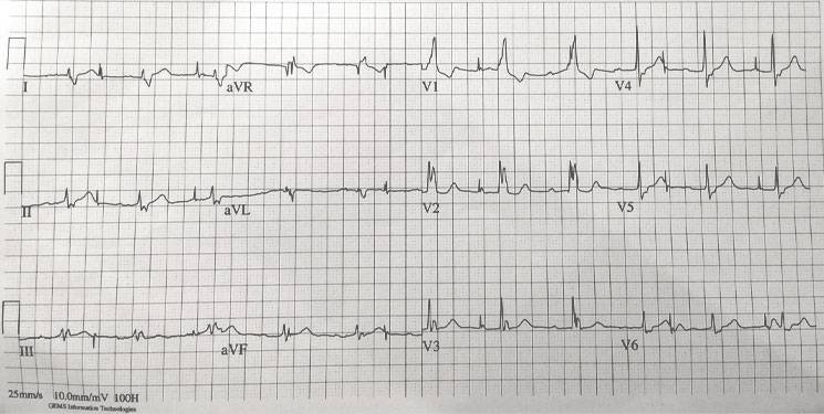 Twelve-lead ECG from an elderly patient after syncope.