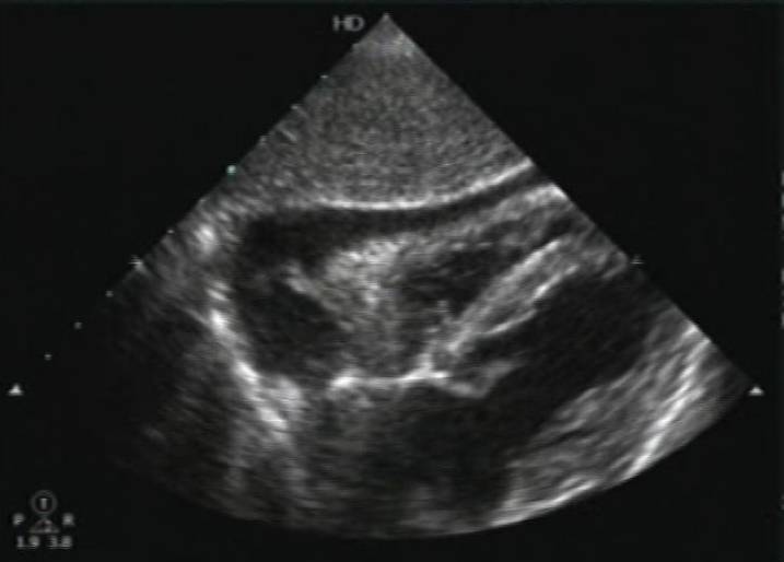 Subxiphoid cardiac ultrasound image from a shocked patient.