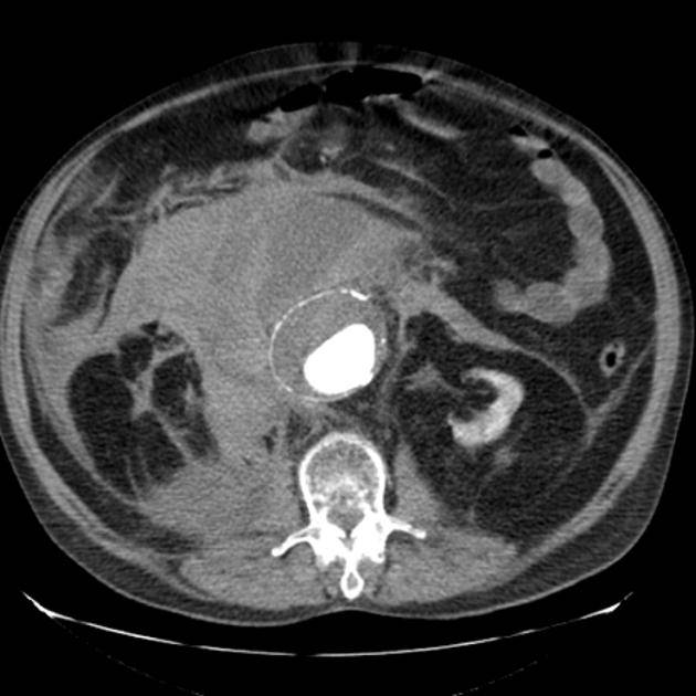Axial abdominal CT image in an elderly patient with severe abdominal pain and shock.