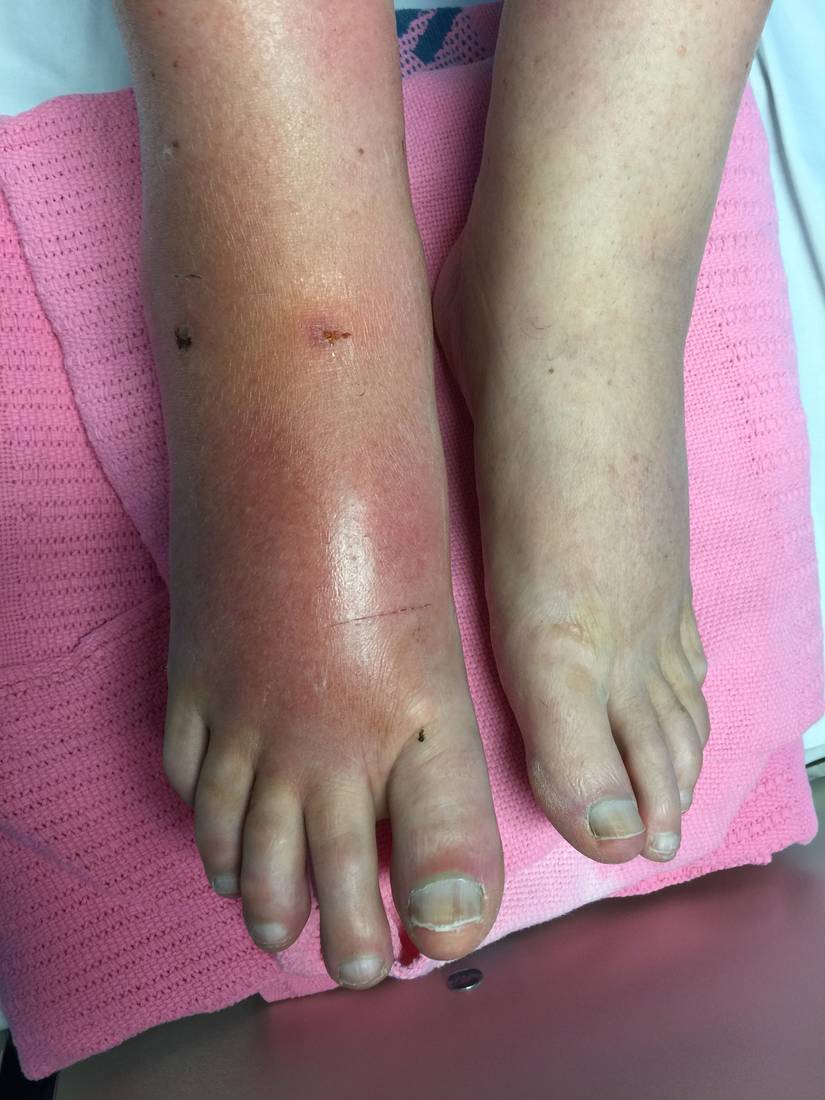 Clinical photograph of an inflamed foot after cat bite.