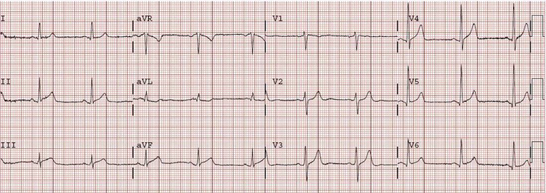 Twelve-lead ECG in a young adult with chest pain and shock.
