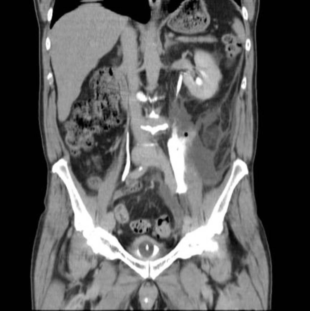 Coronal CT IVP image in a patient with left flank pain.