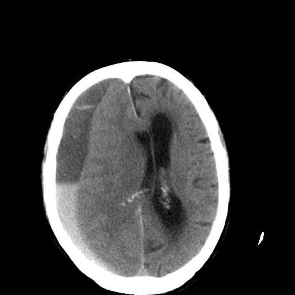 Axial CT brain image in an older driver after trauma.
