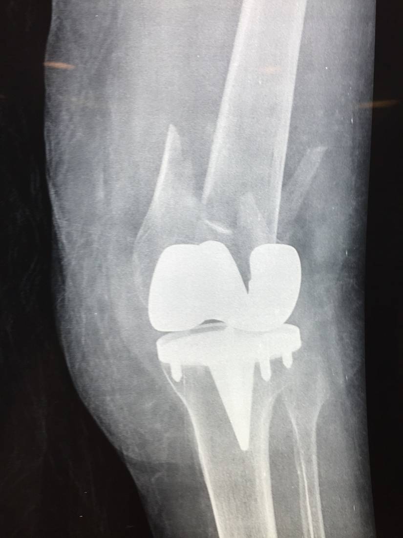Lower limb X-ray in an elderly patient after a fall.