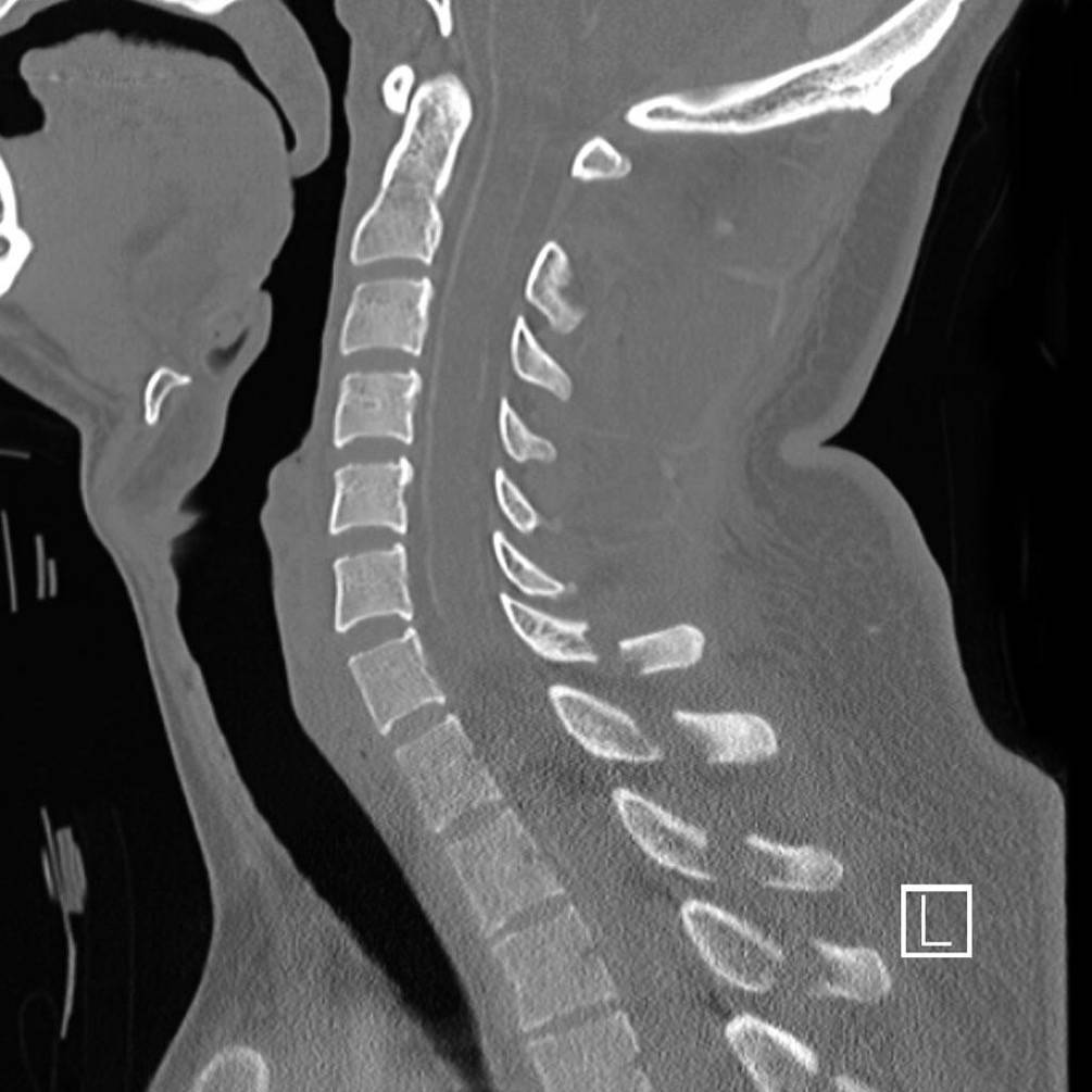 CT cervical spine image after a fall with limb weakness.