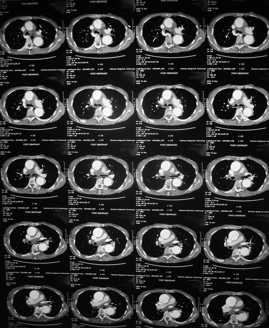 CT aorta image in an elderly patient with severe chest pain radiating to the back.