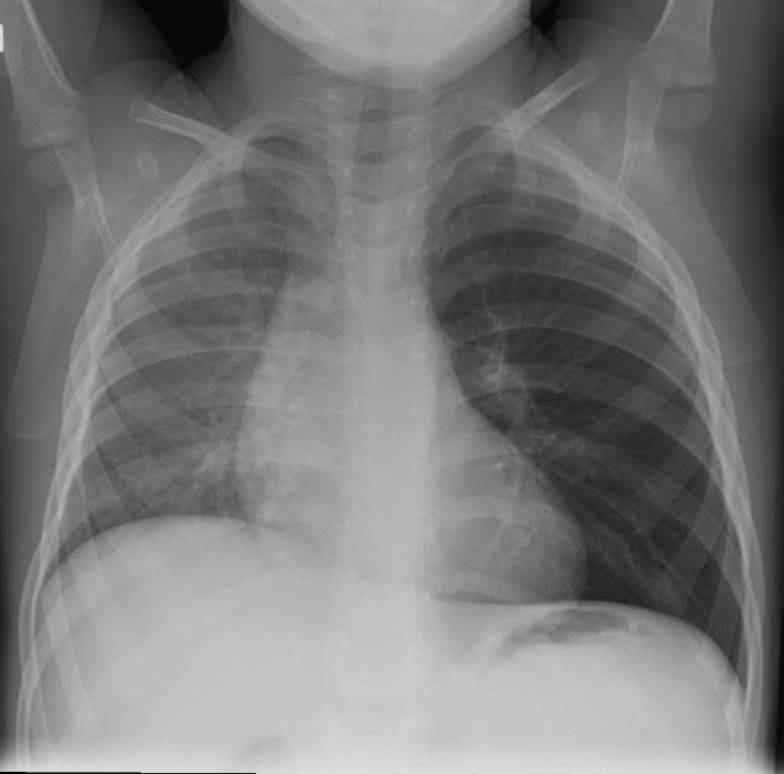 Chest X-ray in a toddler after choking.