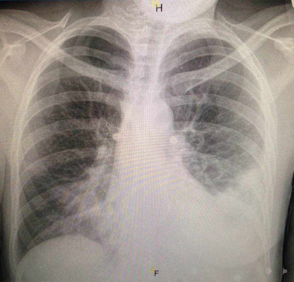 Chest X-ray in an older woman with fever, cough and dyspnoea.