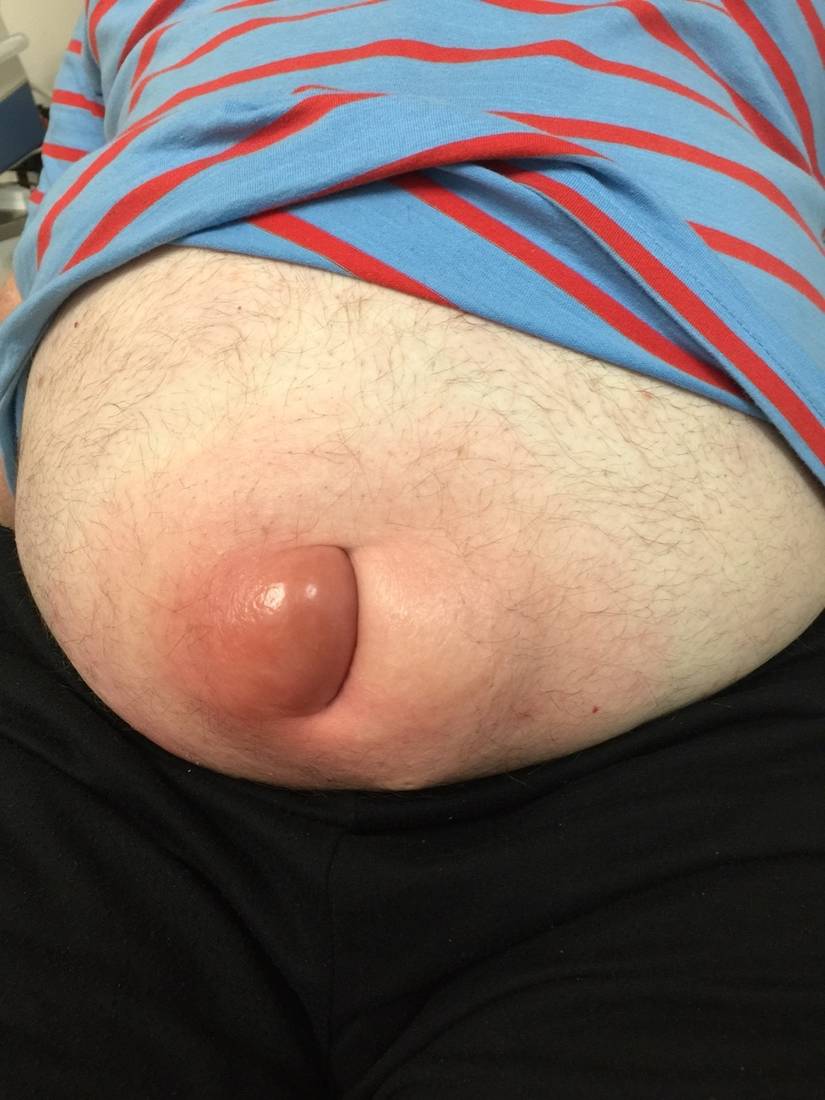 Clinical abdominal photograph in an older man with abdominal pain.