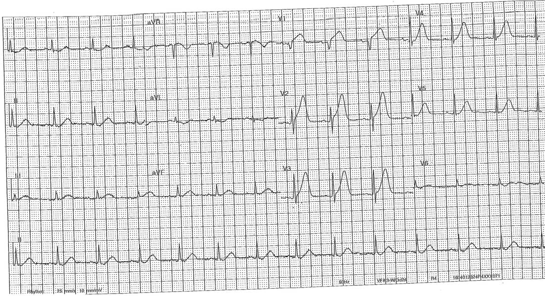 ECG in a man with dyspnoea and chest pressure.