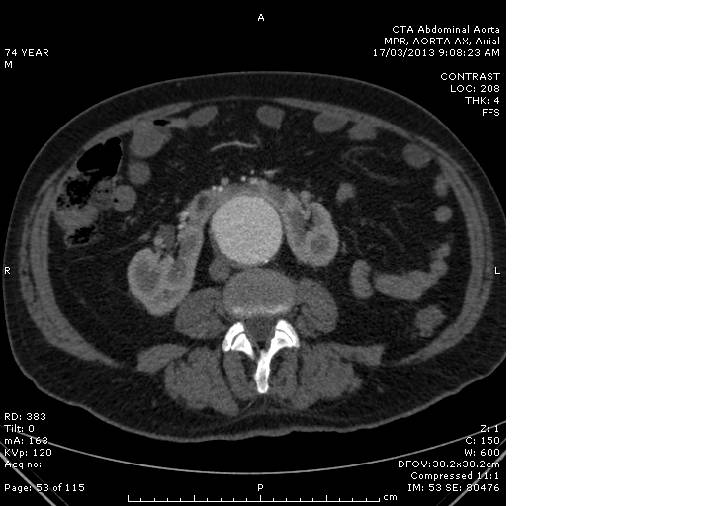 Axial CT abdomen image in an older man with abdominal pain and hypotension.