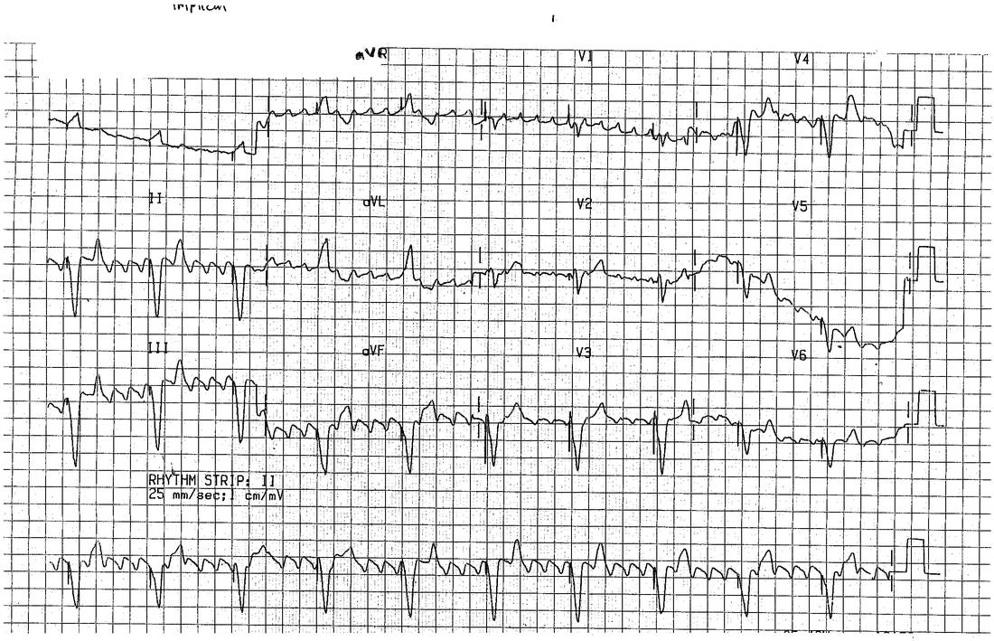 ECG in an older man with marked dyspnoea.