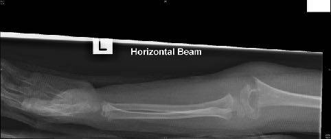 Forearm X-ray after trampoline fall, view 1.