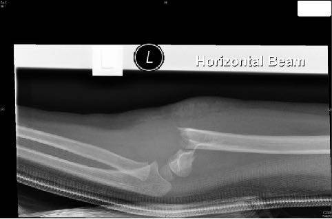Forearm X-ray after trampoline fall, view 2.