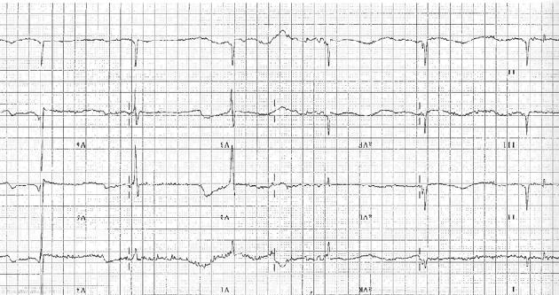 ECG in an older man with hypothermia.